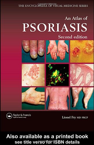 Atlas of Psoriasis