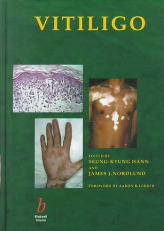 Vitiligo