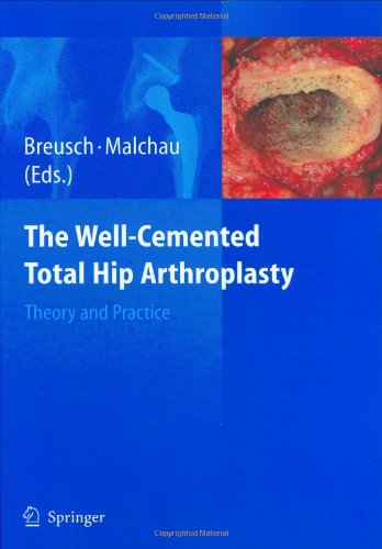 The Well Cemented Total Hip Arthroplasty