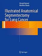 Illustrated anatomical segmentectomy for lung cancer.