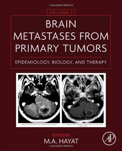 Brain Metastases from Primary Tumors Volume 1