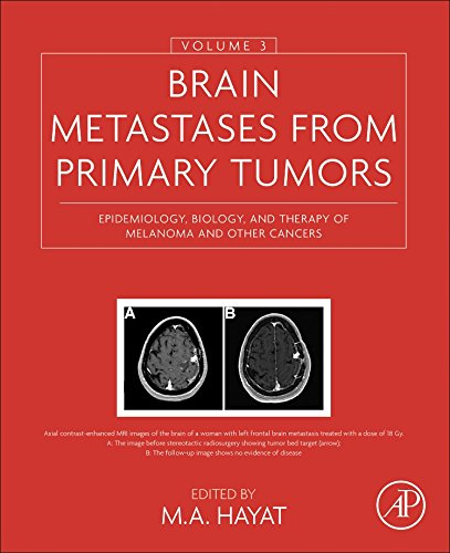 Brain Metastases from Primary Tumors, Volume 3