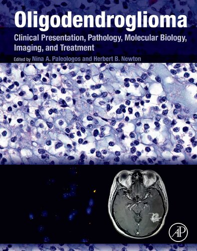 Oligodendroglioma