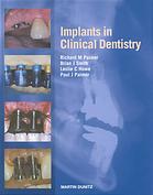 Implants in Clinical Dentistry