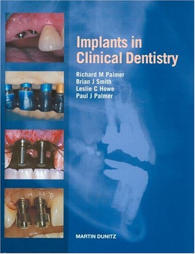 Implants in Clinical Dentistry