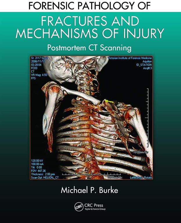 Forensic Pathology of Fractures and Mechanisms of Injury: Postmortem CT Scanning