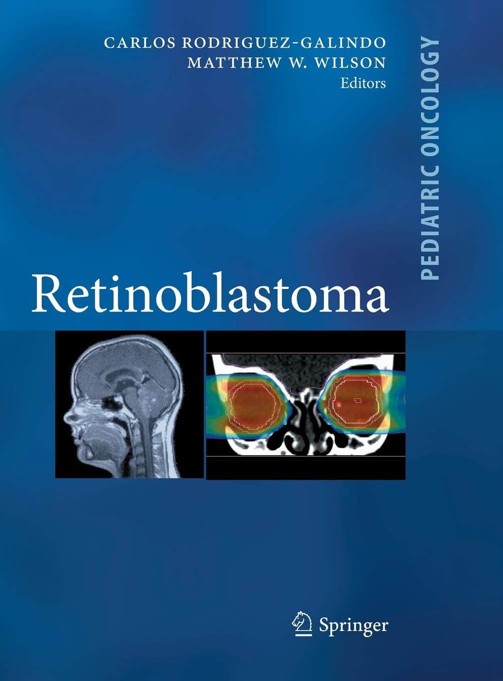 Retinoblastoma (Pediatric Oncology)