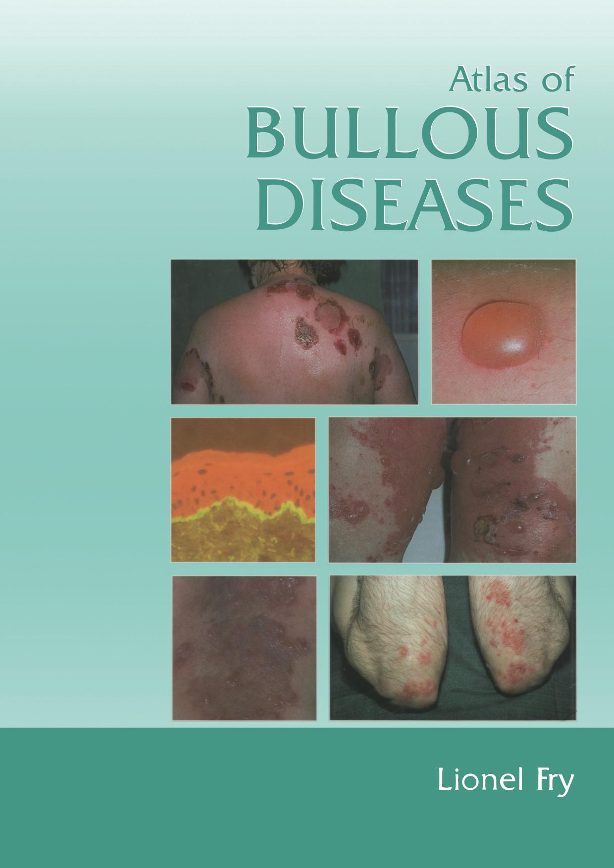 Atlas of bullous diseases