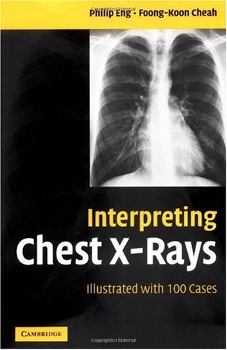 Interpreting Chest X-Rays