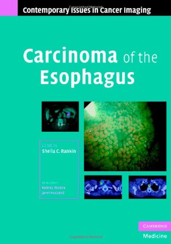 Carcinoma of the Esophagus