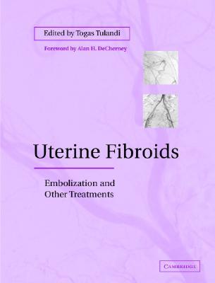 Uterine Fibroids