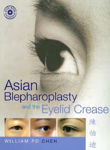 Asian Blepharoplasty and the Eyelid Crease with DVD E-Book