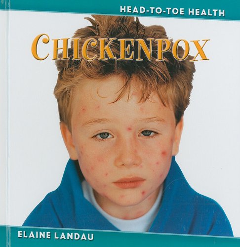 Chickenpox