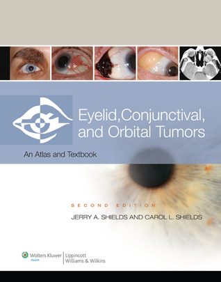 Eyelid, Conjunctival, and Orbital Tumors