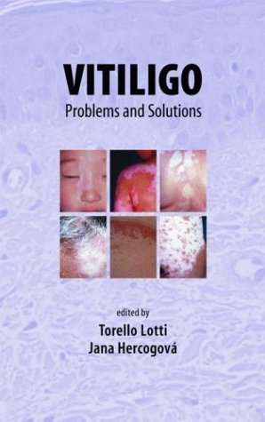 Vitiligo