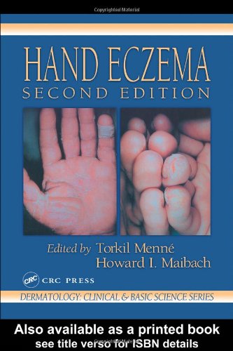 Hand Eczema