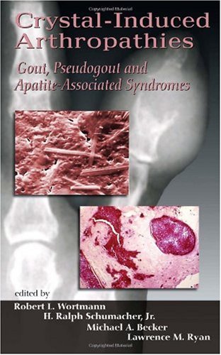 Crystal-Induced Arthropathies