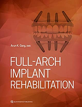 Full-Arch Implant Rehabilitation