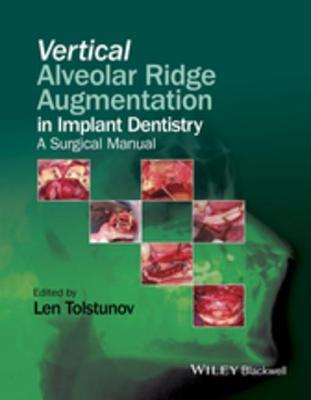 Vertical Alveolar Ridge Augmentation in Implant Dentistry