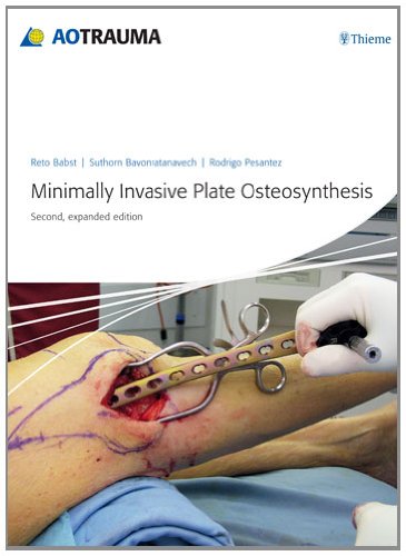 Minimally Invasive Plate Osteosynthesis (Mipo)