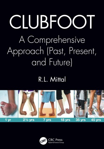 Clubfoot : a comprehensive approach (past, present, and future)