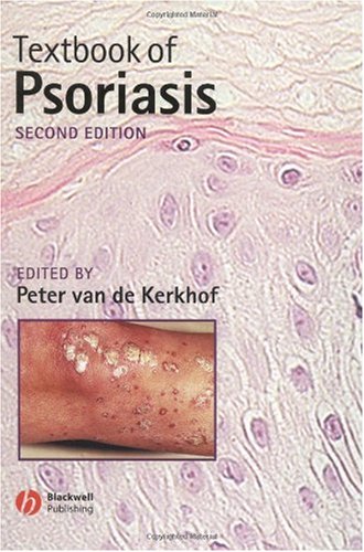 Textbook of Psoriasis