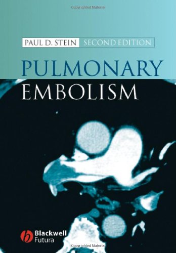 Pulmonary Embolism