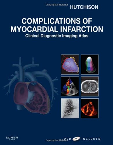 Complications of Myocardial Infarction