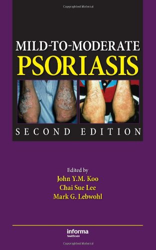 Mild-to-Moderate Psoriasis