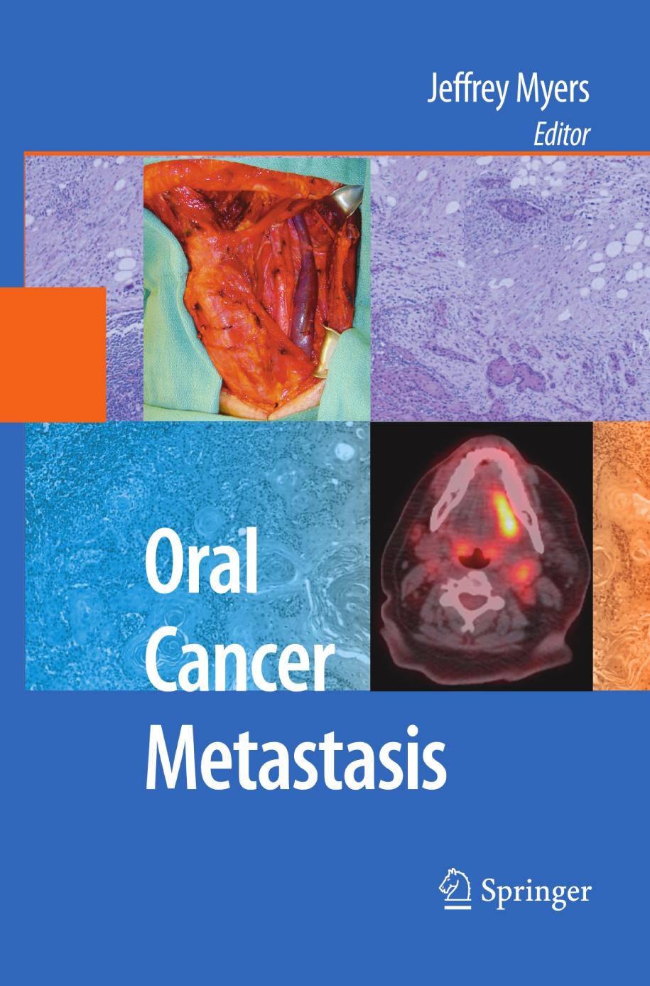 Oral cancer metastasis