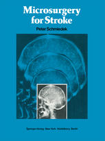 Microsurgery for Stroke