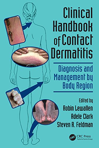 Clinical Handbook of Contact Dermatitis