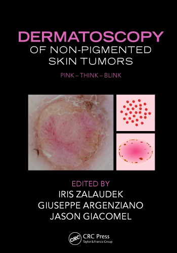 Dermatoscopy of non-pigmented skin tumors : pink-think-blink