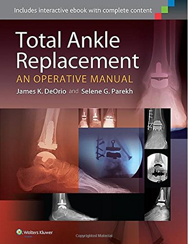 Total Ankle Replacement : An Operative Manual.