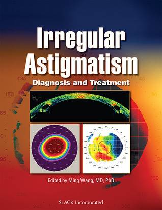 Irregular Astigmatism