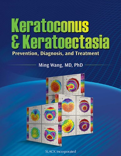 Keratoconus and Keratoectasia