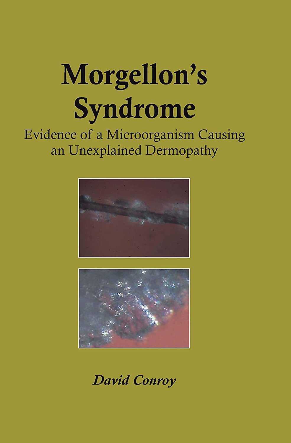 Morgellon's Syndrome