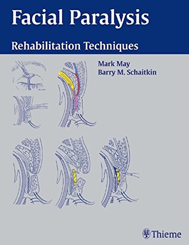 Facial Paralysis