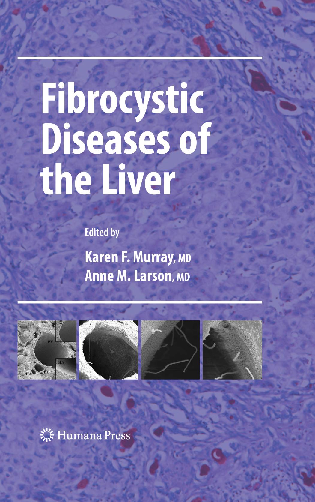 Fibrocystic diseases of the liver