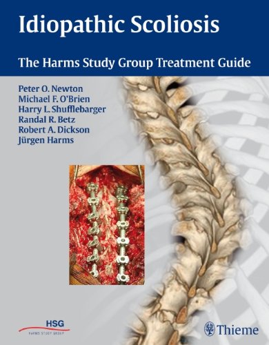 Idiopathic Scoliosis