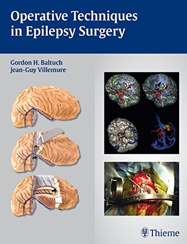 Operative Techniques in Epilepsy Surgery