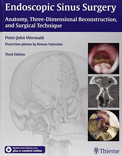 Endoscopic Sinus Surgery