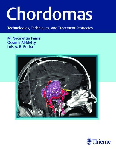 Chordomas