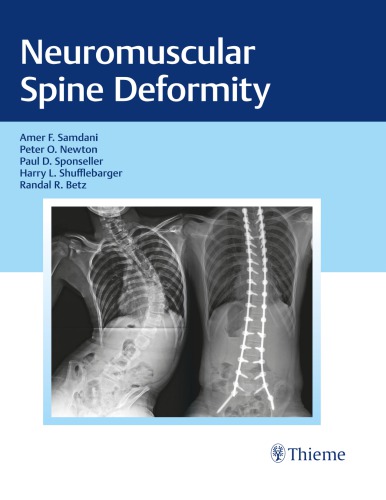 Neuromuscular Spine Deformity