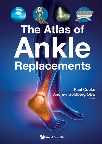 The atlas of ankle replacements