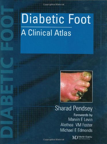 Diabetic Foot