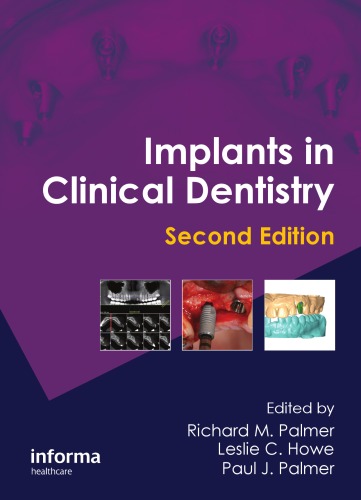 Implants in Clinical Dentistry