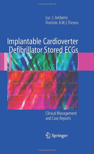 Implantable Cardioverter Defibrillator Stored ECGs