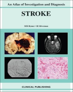 Ischemic Stroke