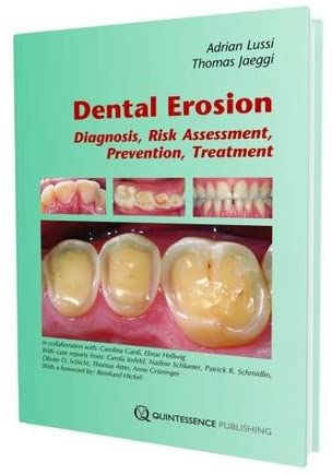 Dental Erosion: Diagnosis, Risk Assessment, Prevention, Treatment